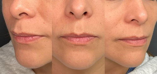 lip fillers before picture